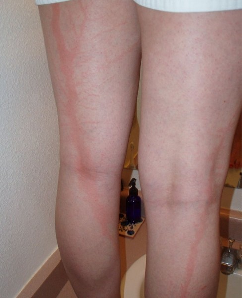 После разряда — что происходит с человеком, в которого ударила молния