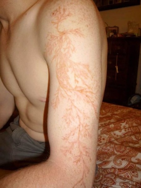 После разряда — что происходит с человеком, в которого ударила молния