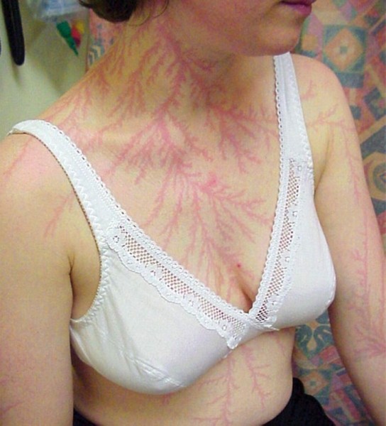 После разряда — что происходит с человеком, в которого ударила молния